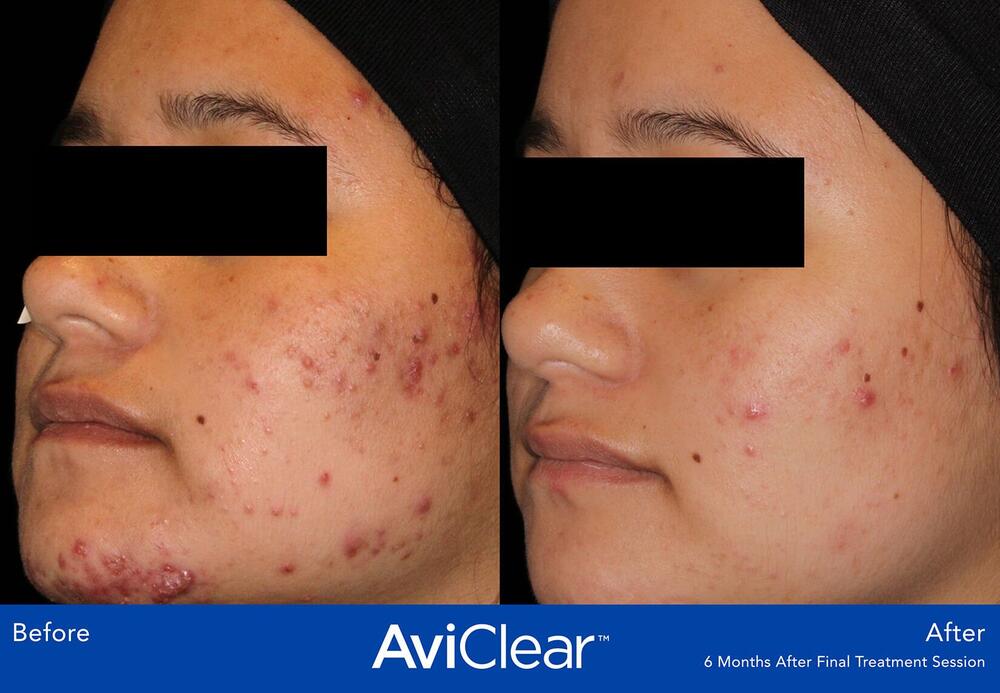 AviClear Laser For Acne Before & After Image