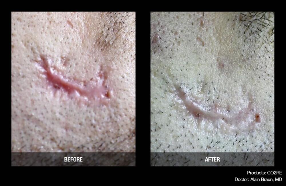 CO2 Resurfacing Before & After Image